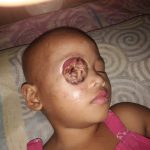 Gadis cilik Usia 4 Tahun Derita Tumor Mata, Butuh Uluran Tangan Dermawan